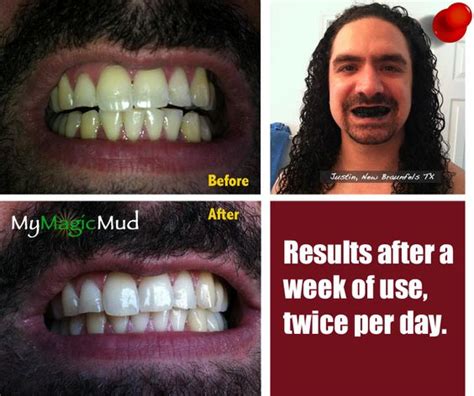 Makic Mud Teeth Whitening: A Step-by-Step Guide to Achieving a Radiant Smile
